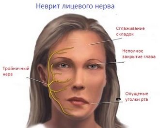 Inflamația simptomelor nervului trigeminal - frumos la modă