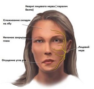 Inflamația simptomelor nervului trigeminal - frumos la modă