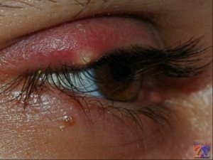 Inflamații și dureri de ochi - ce să faceți despre cum să vă protejați ochii
