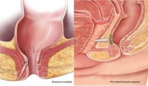 Simptome și tratament pentru paraproctită cronică, chirurgie