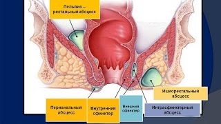 Simptome și tratament pentru paraproctită cronică, chirurgie