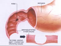 Ulcerul duodenului