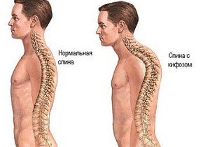 32 fizikoterápia gyakorlatok kyphosis, a nyaki, háti és ágyéki gerinc