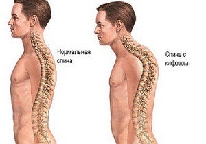 32 Exerciții lfk cu cifoză cervicală, toracică și lombară