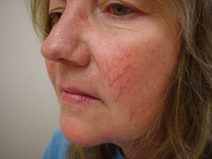 Akne, rosacea, demodicosis és fokozott szőrnövekedés - tünetek