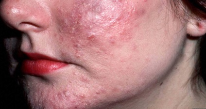 Akne, rosacea, demodicosis és fokozott szőrnövekedés - tünetek