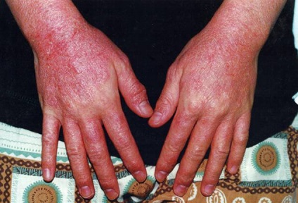 Dermatita alergică alergică și tratamentul dermatitei alergice la copii și adulți