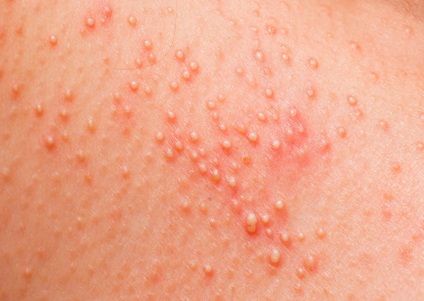 O alergie la piele este ceea ce se întâmplă și cum se face cu ea