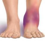 Unguente farmaceutice de la calusuri la nivelul picioarelor, tratamentul picioarelor