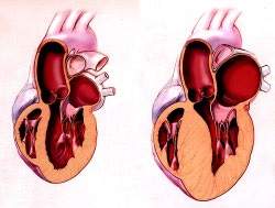 Aritmia inimii după alcool - tratamentul inimii