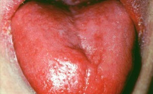 Boala Addison-Birmer - simptome, tratament