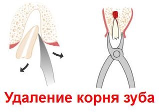 Fáj, ha húzni a fogat eltávolítási eljárás