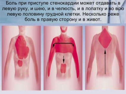 Durerea cu angină pectorală - caracter, durată, localizare, cauze, cupping