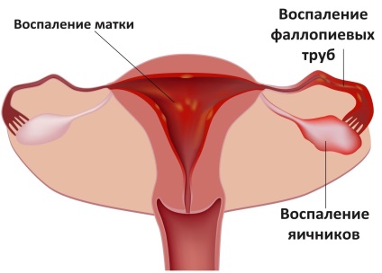 Ovarii și dureri abdominale