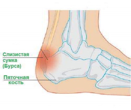 Ce este bursita de călcâi și cum să o tratezi