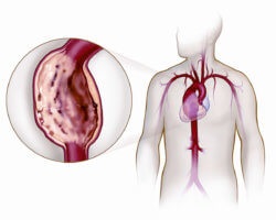 Ce este un test de alergare în cardiologie, numirea, procedura și contraindicațiile