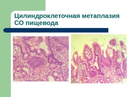 Metaplasia celulelor cilindrice ale cauzelor esofagului, clasificarea, diagnosticul și tratamentul