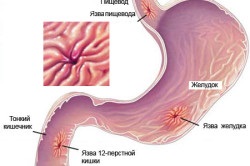 Retardul gastral duodenal (stomacul)