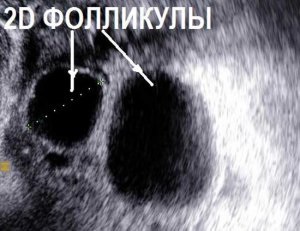 Două foliculi dominante într-un ovar, dezvoltarea a două foliculi în ovarul drept și stâng