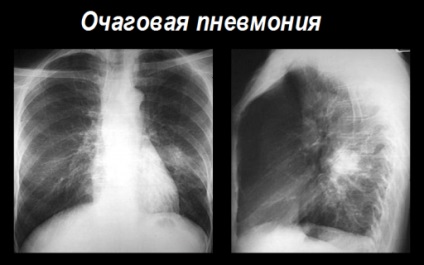 Pneumonie polisergică pneumatică