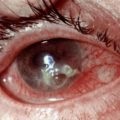 Eroziunea corneei ochiului Reguli de prim ajutor și tratament