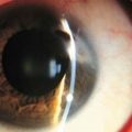 Eroziunea corneei ochiului Reguli de prim ajutor și tratament