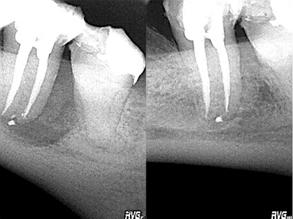 Factori de tratament endodontic de succes