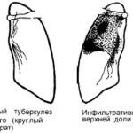 Forme și tipuri de tuberculoză pulmonară