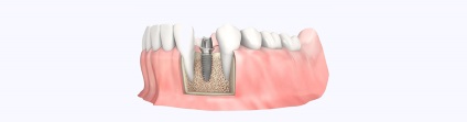 În cazul în care este posibil să se pună implanturi calitativ și inexpensiv