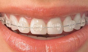 Adânc dinții de tipuri de dinți, cauze, cum să se stabilească - dinte medic