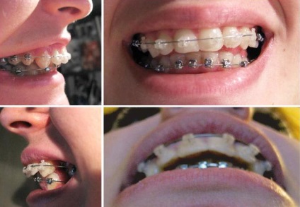 Overbite fogak típusai, okai, hogyan kell megjavítani - Dr. fogat