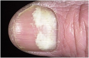 Unghii de ciuperci pe mâinile simptomelor, fotografiilor și cauzelor bolii