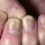 Unghii de ciuperci pe mâinile simptomelor, fotografiilor și cauzelor bolii