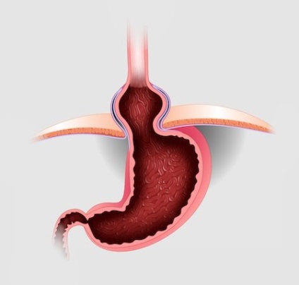 Hernia stomacului, operație