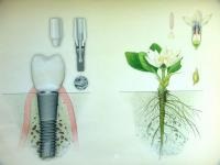 Implantarea dinților - know-how-ul dentar, protetica și implantarea dinților la Moscova