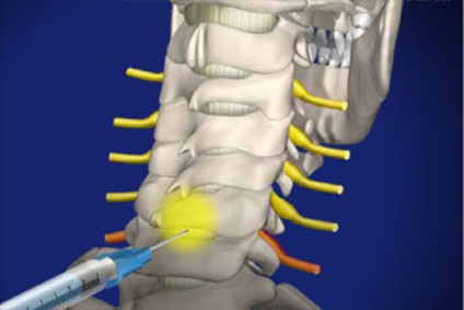 Injecții cu cortizon, tipuri de injecții, beneficii și complicații