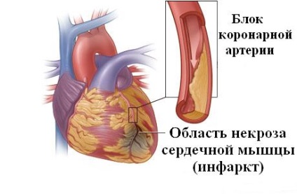 Infarctul miocardic, tratamentul cu remedii folclorice la domiciliu