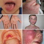 Mononucleoza infecțioasă la copii, cauze, simptome, diagnostic, tratament și prevenire a video