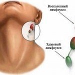 A mononucleosis infectiosa gyermekeknél típusú, okai, tünetei, diagnózis, kezelés és a megelőzés videó