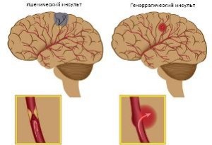 Accident vascular cerebral ischemic și hemoragic - tratament cardiac