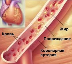 Cardiomiopatia ischemică și simptomele ischemiei miocardice, factori, metode de tratament