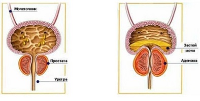 Ce exerciții sunt recomandate pentru prostatită și adenom de prostată