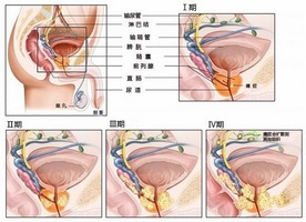 Ce exerciții sunt recomandate pentru prostatită și adenom de prostată