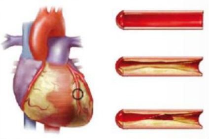 Cum se trateaza ateroscleroza vaselor cu remedii naturale - longevitate sanatoasa