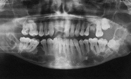 Chistul maxilarului inferior revizuiește operația pe maxilarul superior, keratokist, tratament și simptome (foto