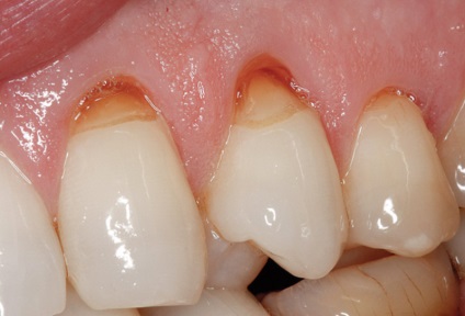 Defecțiune cuneoidă - defecte ale dinților, cum se tratează un dinte sferoid