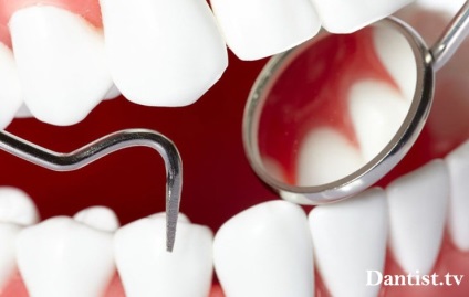 Defecte cuneiforme ale dinților, cauze, metode de tratament