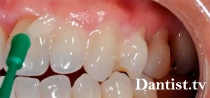 Defecte cuneiforme ale dinților, cauze, metode de tratament