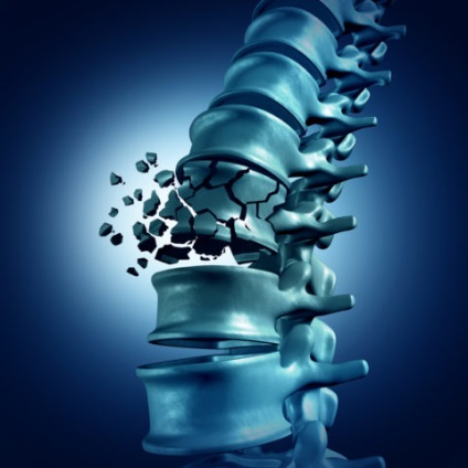 Fractura compresivă a simptomelor coloanei vertebrale, traumatologie