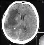 Tomografia computerizată în accident vascular cerebral